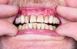 Types of Gum Disease (Periodontal Disease): Gingivitis and Periodontitis