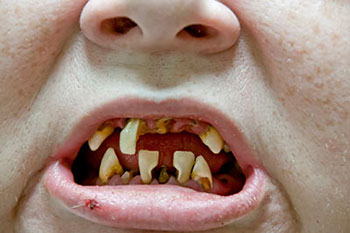 Babies can get cavities, and other surprising facts from a Broomfield dentist.