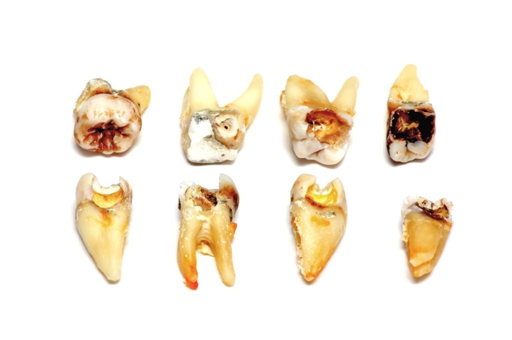 Tooth Decay: Causes, Symptoms and Treatment