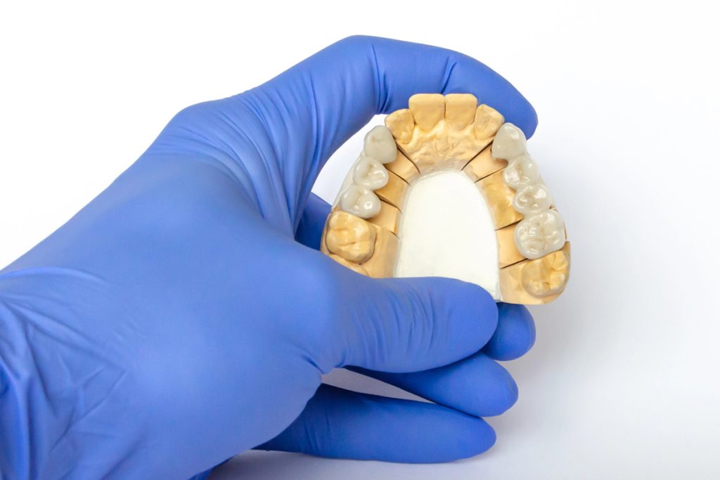A gloved hand holding a dental model of the upper teeth, showing crowns and restorations against a white background.