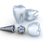 Dental implants prevent bone loss