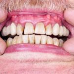 Types of Gum Disease (Periodontal Disease): Gingivitis and Periodontitis
