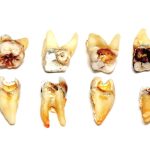 Tooth Decay: Causes, Symptoms and Treatment