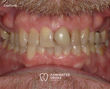 Full mouth restoration before with improved alignment and brighter smile at Hawkins Rainwater Dental Group.