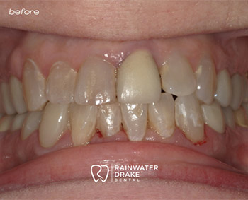 Porcelain veneers before correcting uneven and discolored teeth.