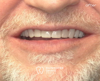 Dental implants and crowns after restoring missing teeth at Hawkins Rainwater Dental Group.