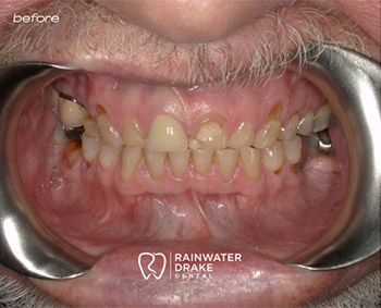 Dental implants and crowns before restoring missing teeth at Hawkins Rainwater Dental Group.