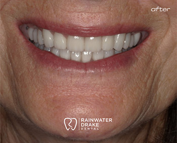 Cosmetic dentistry after improving shape, color, and symmetry.