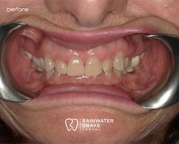 Cosmetic dentistry before improving shape, color, and symmetry.