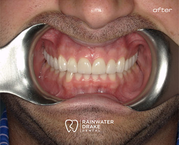 Teeth whitening after with a brighter, cleaner smile at Hawkins Rainwater Dental Group.