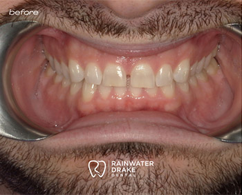 Teeth whitening before with a brighter, cleaner smile at Hawkins Rainwater Dental Group.